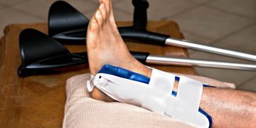 Frattura caviglia: come riconoscerla, sintomi e tempi di recupero