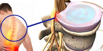 Ernia dorsale: cause, sintomi, cosa fare, cure ed esami diagnostici