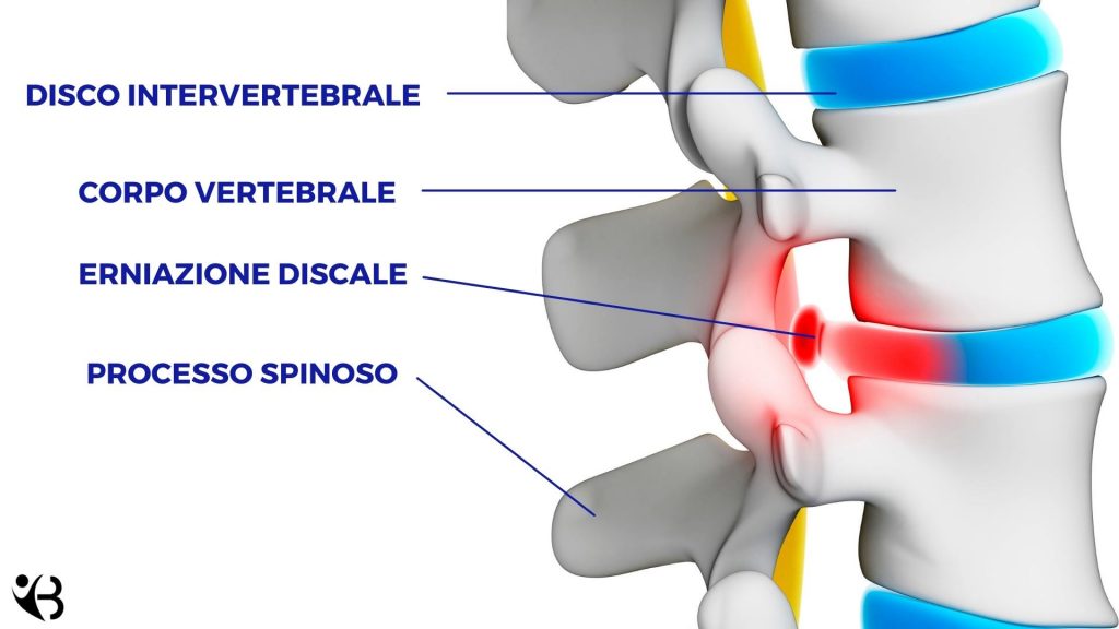 Ernia Dorsale Cause Sintomi Cosa Fare Cure Ed Esami Diagnostici Dott Valerio Barbari